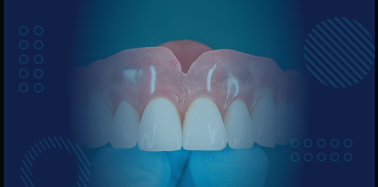 Full Denture, Porcelain Teeth (upper or lower)